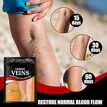 Parches para varices